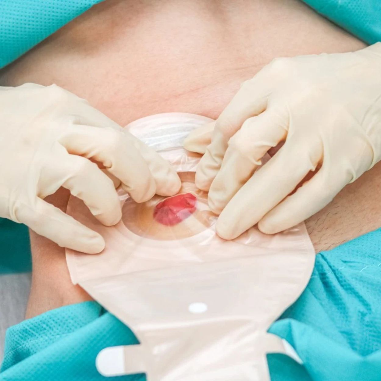 EVDE YARA TAKİBİ VE STOMA DEĞİŞİMİ